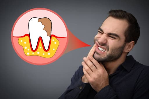 Dental Abscess You Shouldn’t Ignore