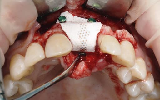 Emergency Broken Tooth Replacement