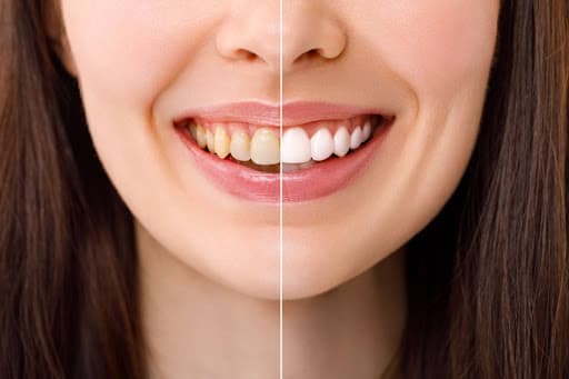 Long-Lasting Teeth Whitening Results