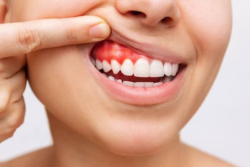 The Stages of Gum Disease