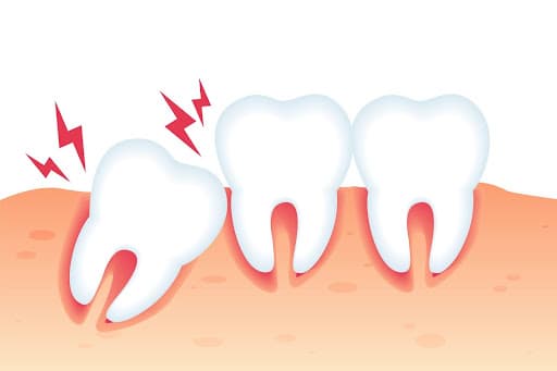 Treatments for Hyperdontia