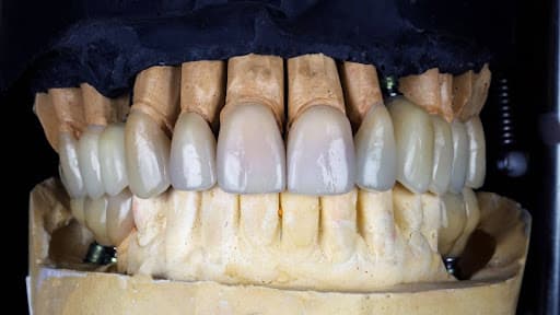 Understanding Different Dental Bridge Types