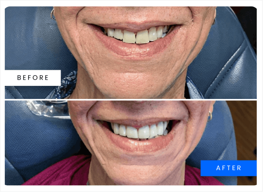 Before and after smile result