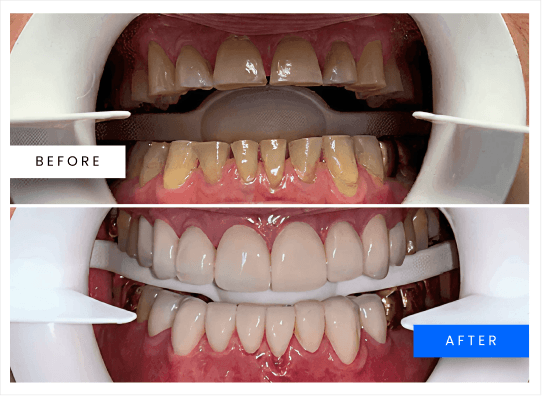 Before and after full restoration result