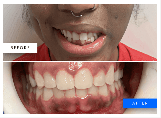 Before and after Invisalign result