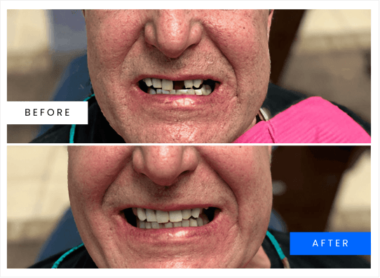 Before and after dental implant result