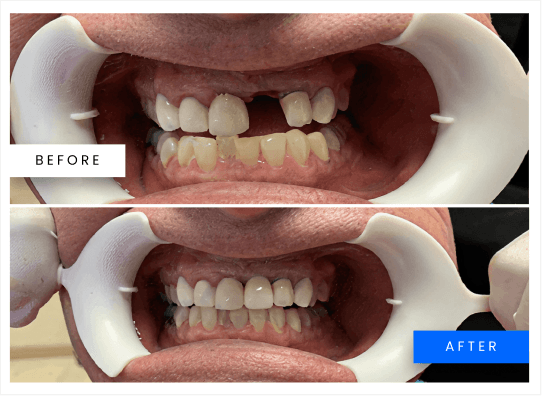 Before and after whitening result