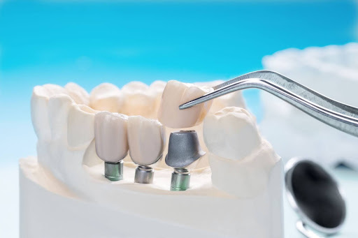 Dental-Implant-Risks-&-Safety