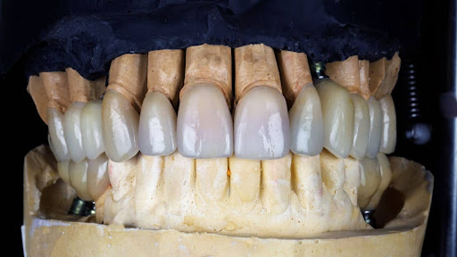 Understanding Different Dental Bridge Types