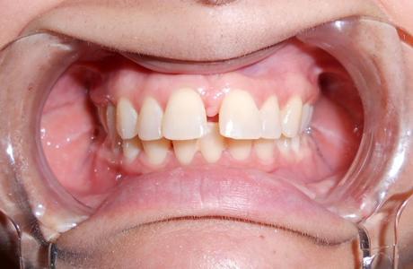 FastBraces 1