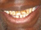 Dental-Veneers-Before-Image