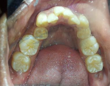 FastBraces 2