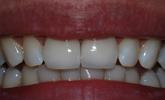 Broken-Front-Tooth-After-Image