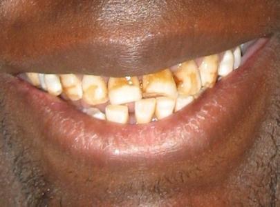 Dual_Arc_Dental_Veneers 1