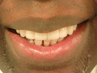 Dual_Arc_Dental_Veneers